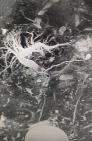 成人的重大疾病手术的瓶颈突破