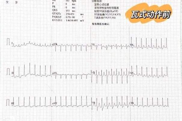 15秒！急救小组扭转了182次/分钟的致命心