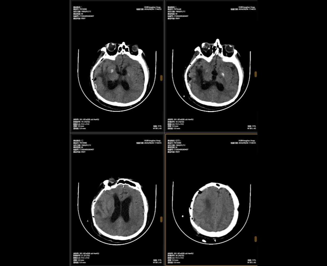 300天的生死存亡！湖北航天医院帮助严重车祸患者重获新生