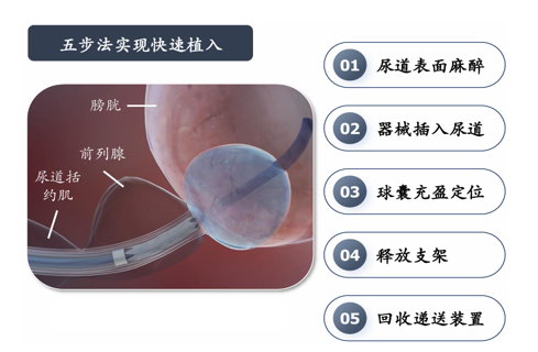 15分钟开启你的人生频道！荆州医生用支架解决男性问题