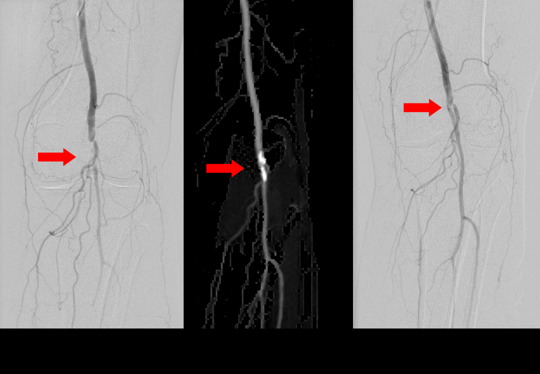 你72岁的奶奶的脚走几步就疼吗？事实上，血管已经“生锈”了！