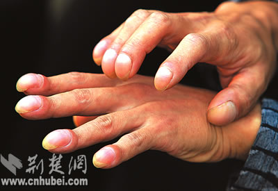 武汉一小伙子双手似鹰爪 指甲盖厚指甲很卷曲