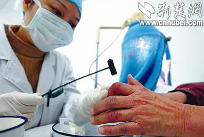 梅花针治冻疮(图)