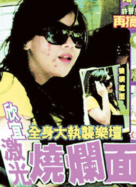 美容变毁容 郑欣宜激光美白烧伤脸(图)