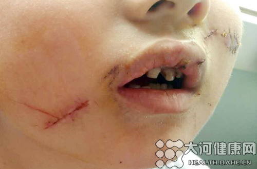 7岁孩子被妈妈强行灌感冒药 面部割伤险毁容