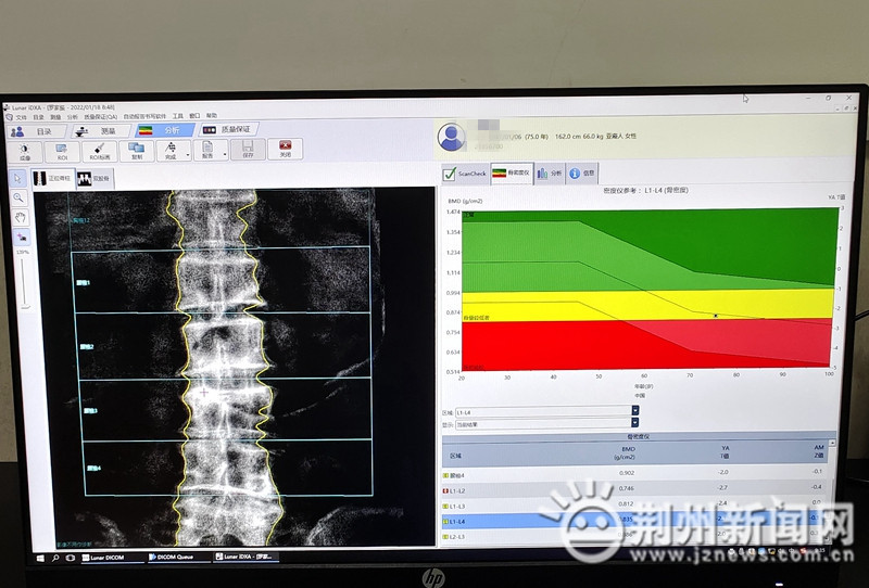 湖北首家荆州市中心医院全新骨密度检测设备重装上线