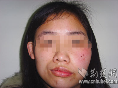 面部畸形大三女生求职难