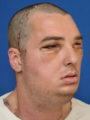 美毁容男相貌怪异似猿猴 面部移植手术全程曝光(图)